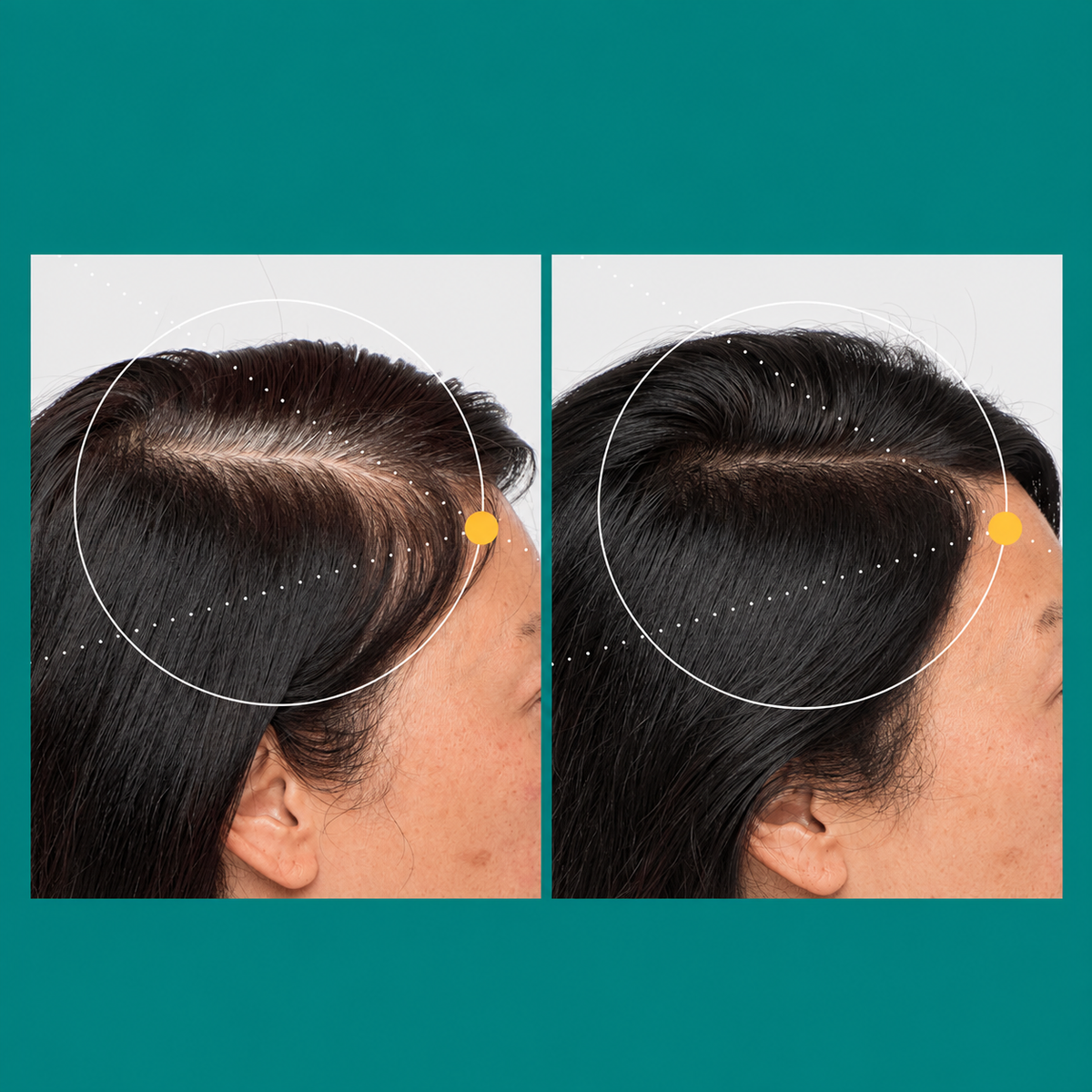 Nutrafol Women 18–44