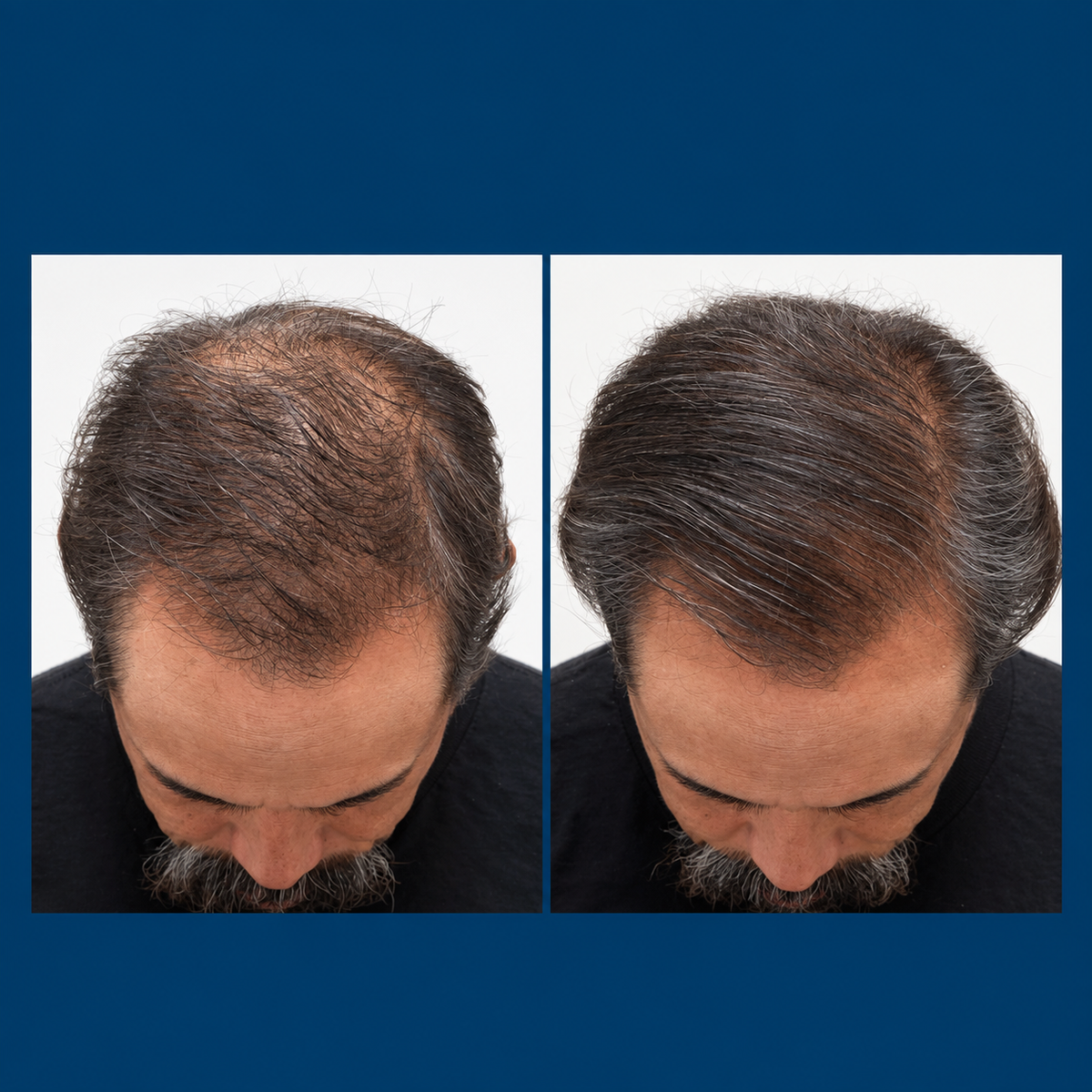 Nutrafol Men 50+