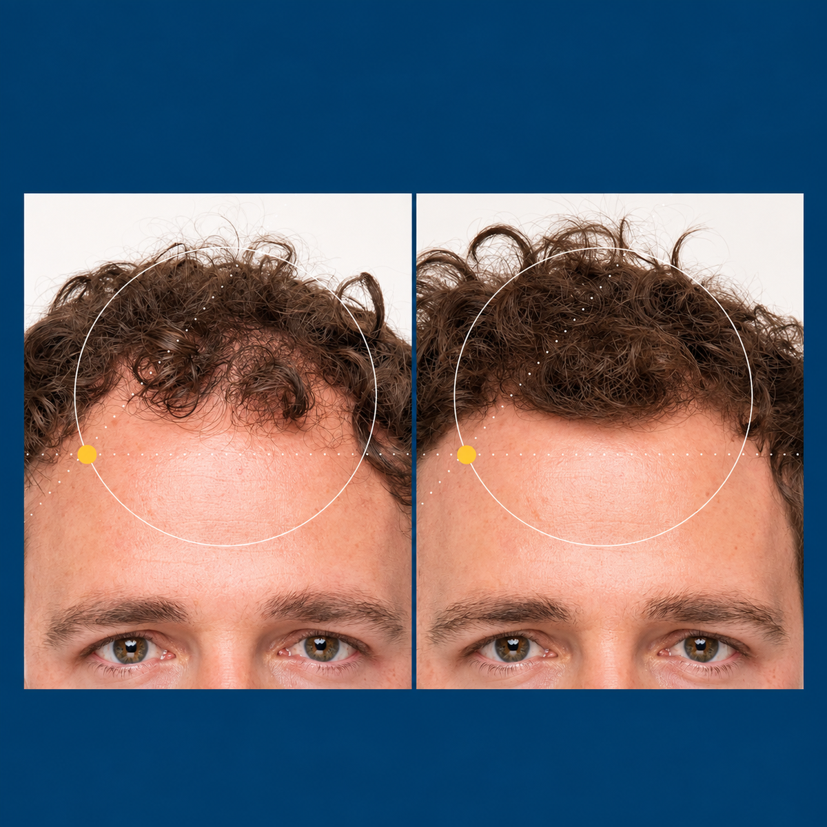 Nutrafol Men 18–49